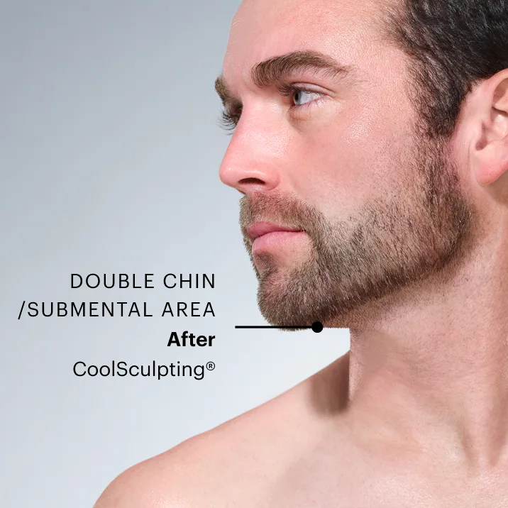 Does CoolSculpting® reduce double chins?